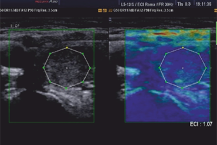 E-Thyroid™ (ElastoScan™ for Thyroid)