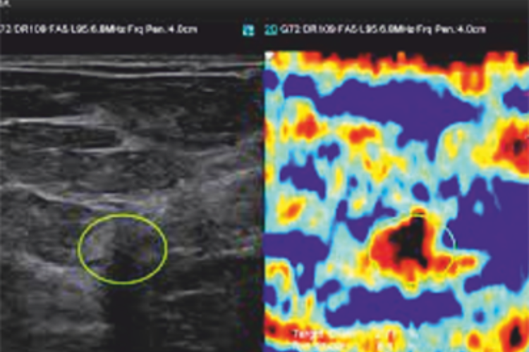 E-Breast™ (ElastoScan™ for Breast)