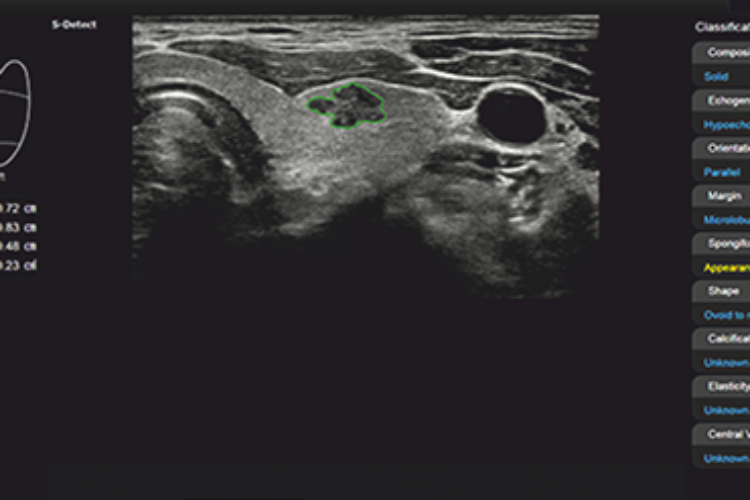 S-Detect™ for Thyroid